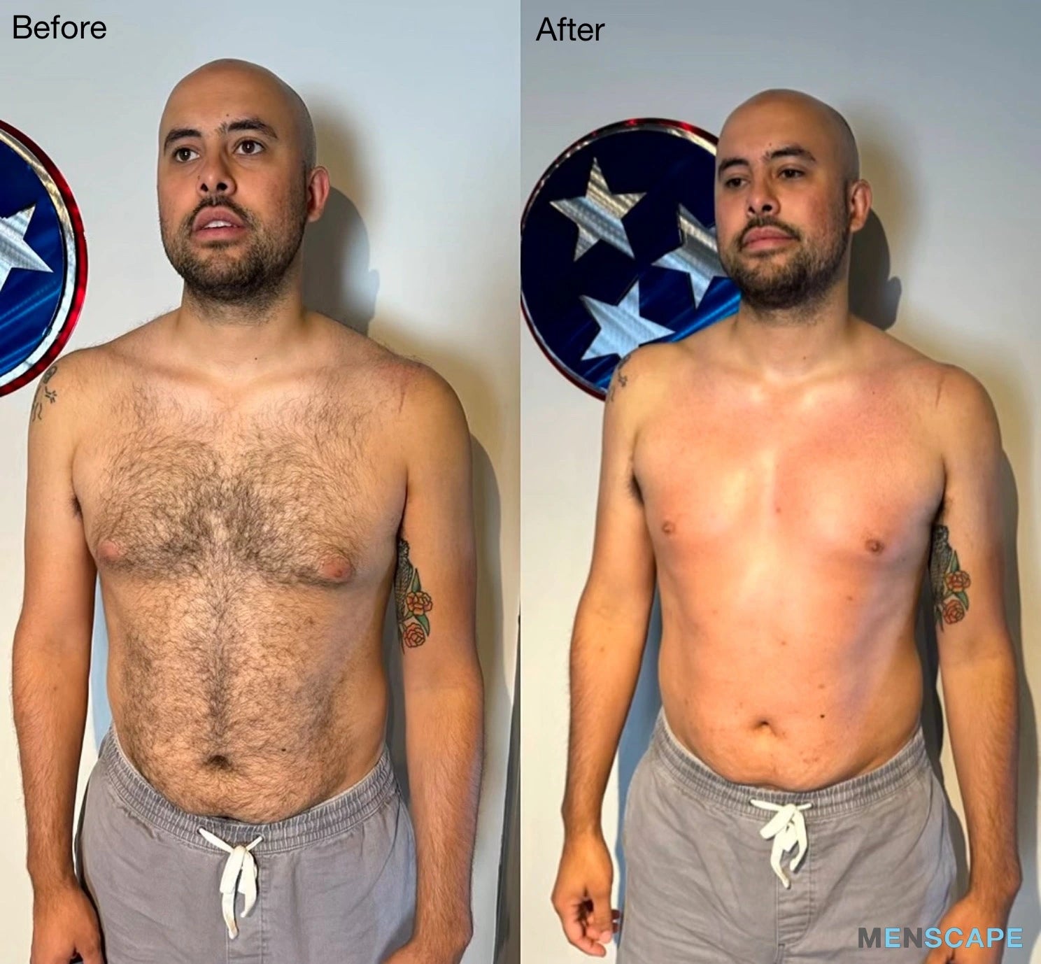 Before and after chest wax client at menscape nashville